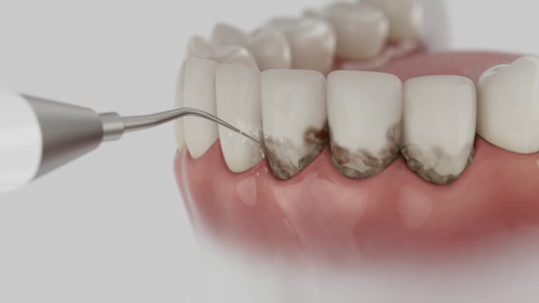 Trusted Wisdom Tooth Removal service in Riverton, UT - Dentist Open Now
